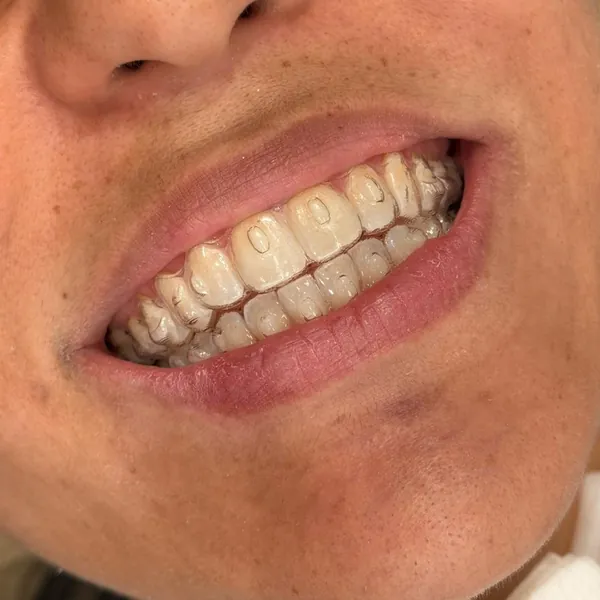 Sorriso de uma paciente usando o alinhador transparente nos dentes.