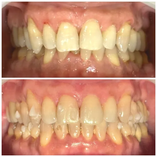 Antes e depois de um tratamento com alinhadores transparentes: em cima, os dentes desalinhados; embaixo, os dentes alinhados.