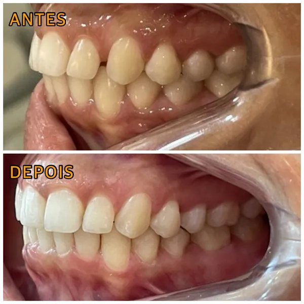 Antes e depois de um tratamento com alinhadores transparentes, de lado: em cima, os dentes desalinhados; embaixo, alinhados.