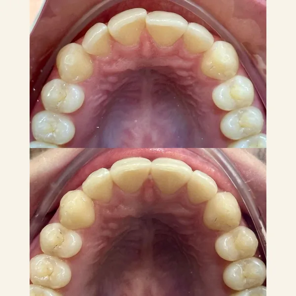 Antes e depois de um tratamento com alinhadores transparentes, a arcada de cima vista por baixo: em cima, os dentes encavalados; embaixo, alinhados.