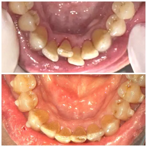 Antes e depois de um tratamento com alinhadores transparentes, a arcada de baixo vista de cima: em cima, os dentes da frente encavalados; embaixo, alinhados.