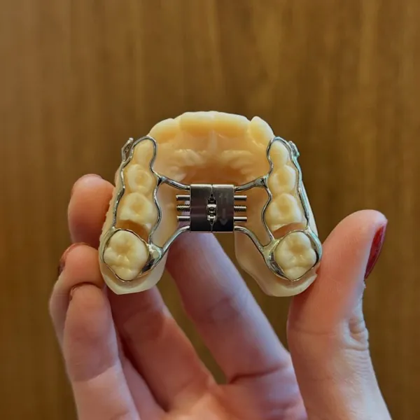 Mão segurando um aparelho expansor preso a um modelo de gesso dos dentes de cima.