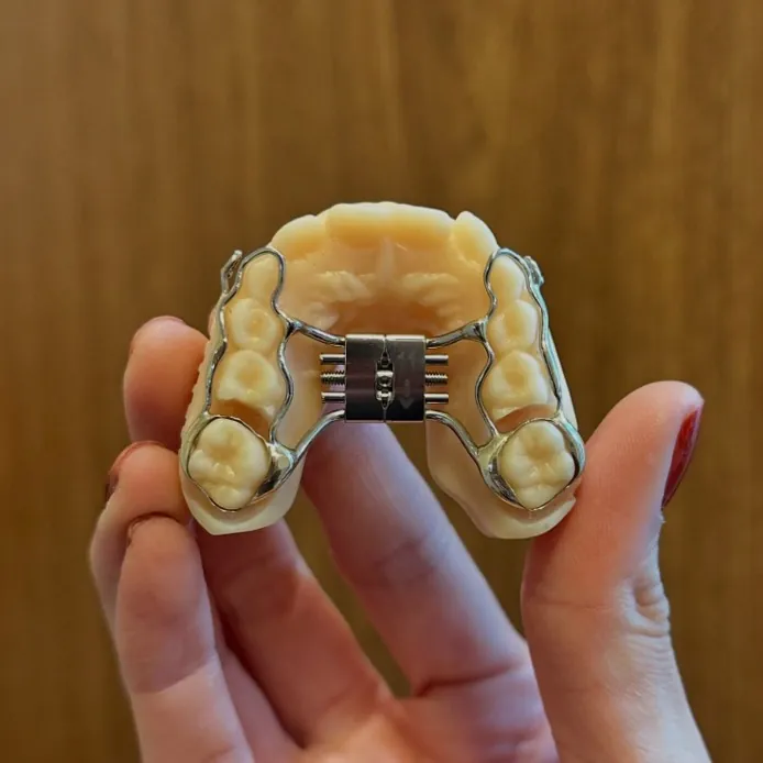 Mão segurando um aparelho expansor do tipo Hyrax preso a um modelo de gesso dos dentes de cima.