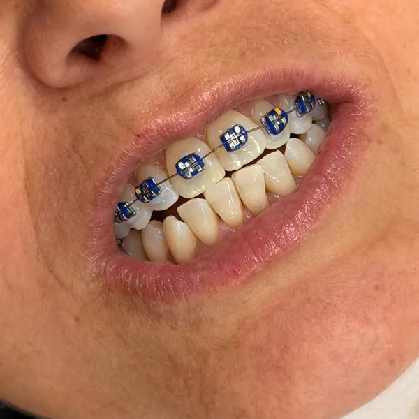 Sorriso de uma paciente com aparelho metálico, de borrachinhas azuis.