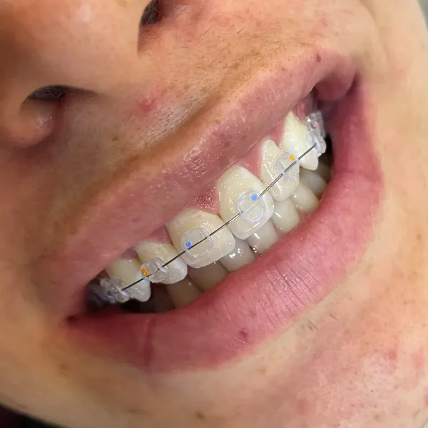 Sorriso de uma paciente com aparelho de safira, de braquetes transparentes.