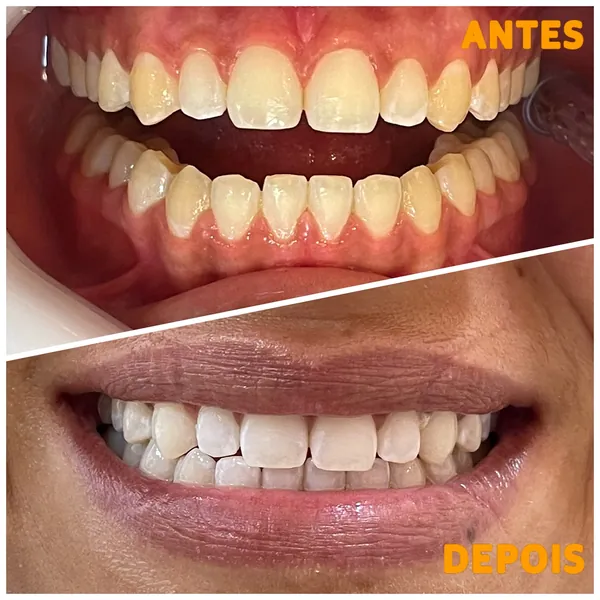 Antes e depois de um clareamento: em cima, os dentes amarelados; embaixo, o sorriso com os dentes mais claros.