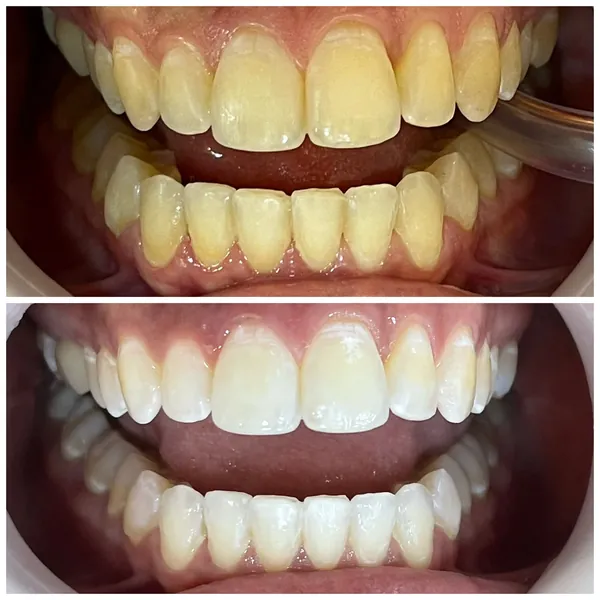 Antes e depois de um clareamento, de frente: em cima, os dentes amarelados; embaixo, os mesmos dentes mais claros.