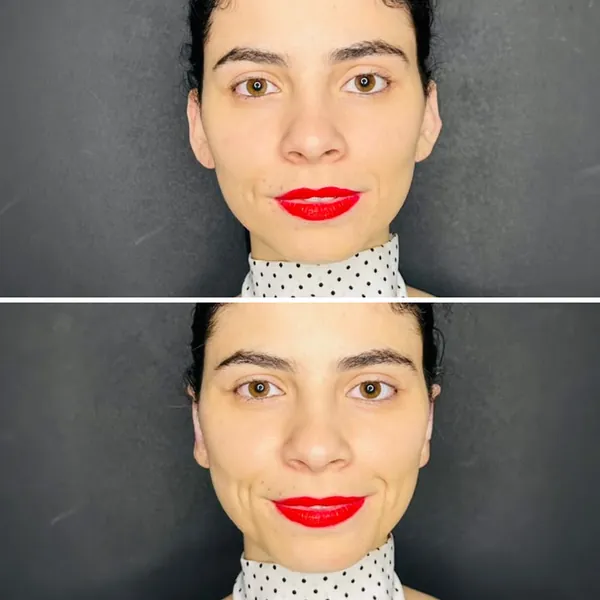Antes e depois de uma otomodelação em uma paciente, de frente: em cima, as orelhas aparecendo dos lados do rosto; embaixo, as orelhas quase escondidas.