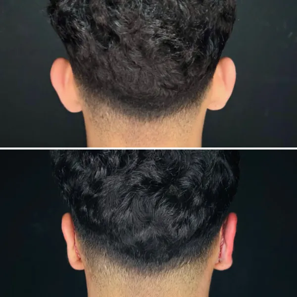 Antes e depois de uma otomodelação, vista de costas: em cima, as orelhas afastadas da cabeça; embaixo, as orelhas mais próximas da cabeça.