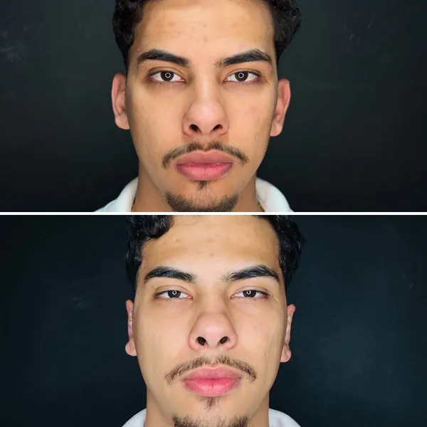 Antes e depois de uma otomodelação, de frente: em cima, as orelhas aparecendo dos lados do rosto; embaixo, as orelhas mais próximas da cabeça.