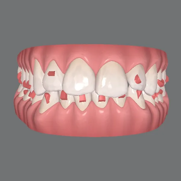 Tela do planejamento digital de um caso: os dentes em 3D, vistos de frente.