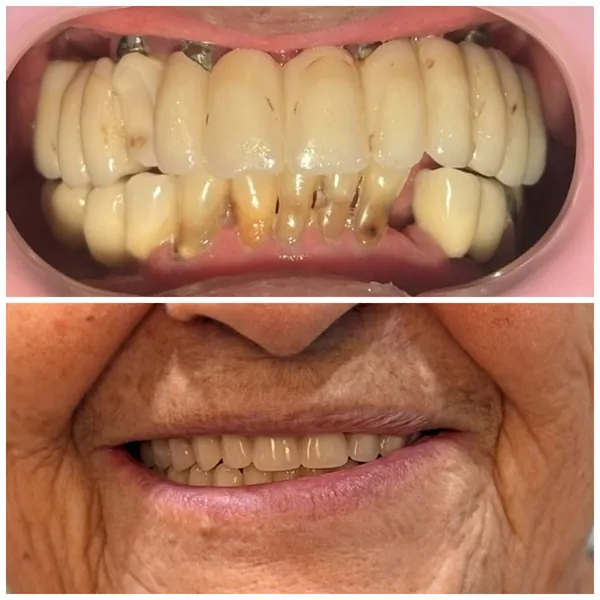 Duas fotos de um caso: em cima, a boca com uma prótese antiga nos dentes de cima e os dentes de baixo desgastados e manchados; embaixo, o sorriso da paciente com os dentes uniformes.