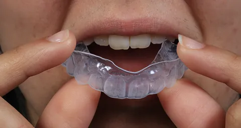 Moldeira com o gel sendo levada aos dentes de cima.