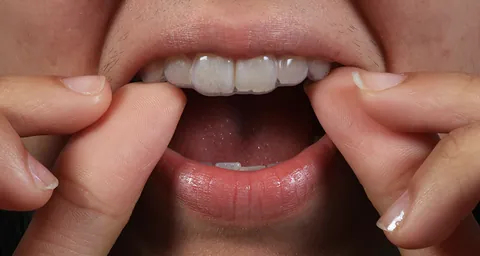 Moldeira encaixada nos dentes de cima, com o sorriso à mostra.