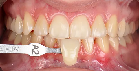 Dentes amarelados no começo do clareamento, ao lado da escala de cor na marca A2.