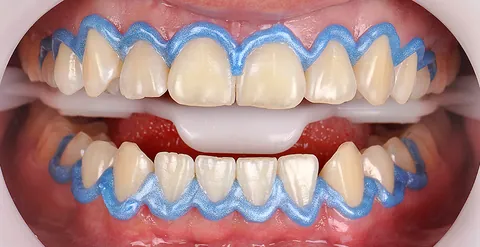 Afastador nos lábios e uma barreira azul protegendo a gengiva dos dentes de cima e de baixo.