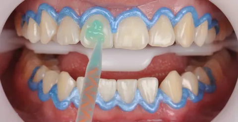 Aplicação do gel clareador nos dentes da frente, com uma ponteira.