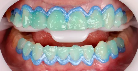 Gel clareador verde sobre os dentes de cima e de baixo, com a gengiva protegida pela barreira azul.