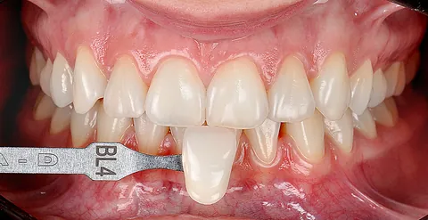 Os mesmos dentes mais claros no fim do clareamento, ao lado da escala de cor na marca BL4.
