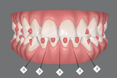 Segundo caso: os dentes em 3D vistos de frente, no começo do planejamento, com os attachments marcados em vermelho.