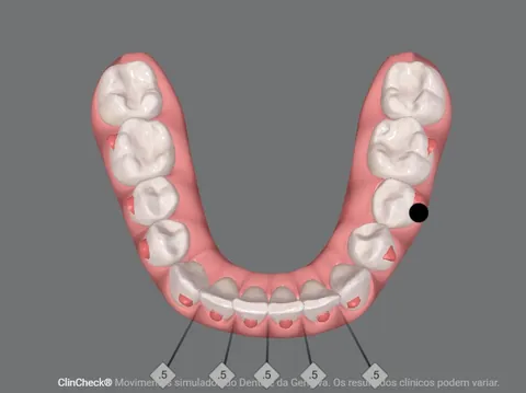 A mesma arcada de baixo, em outra etapa do planejamento, com os dentes da frente alinhados.