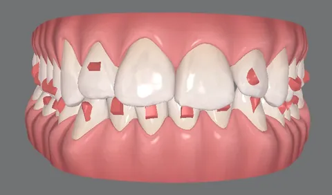 Tela do planejamento digital: os dentes em 3D, vistos de frente.