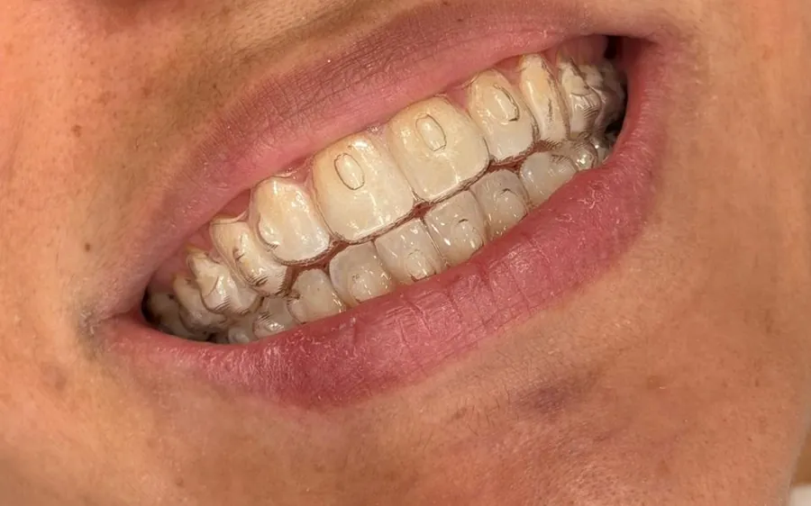 Sorriso de uma paciente do Instituto usando o alinhador transparente nos dentes.