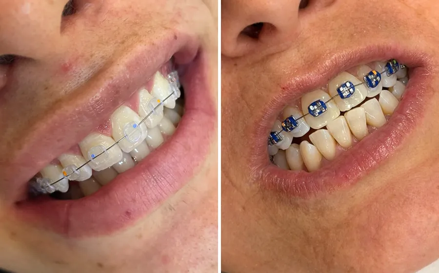 Dois sorrisos de pacientes do Instituto com aparelho fixo: à esquerda, de safira, com braquetes transparentes; à direita, metálico, com borrachinhas azuis.