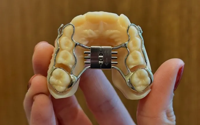 Mão segurando um aparelho expansor preso a um modelo de gesso dos dentes de cima.