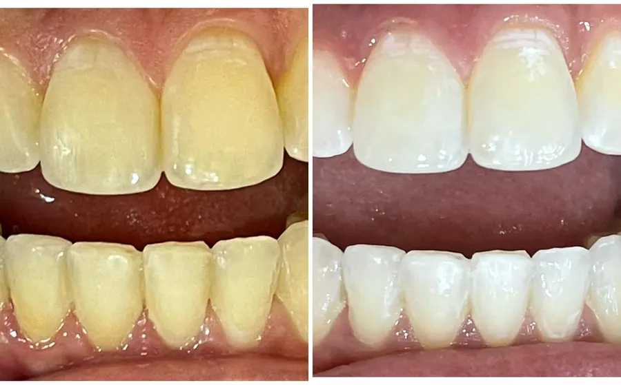 Antes e depois de um clareamento feito no Instituto: à esquerda, os dentes amarelados; à direita, os mesmos dentes mais claros.