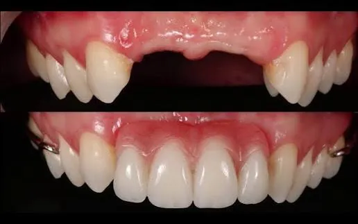 Antes e depois de um caso do Instituto: em cima, a falta dos dois dentes da frente de cima; embaixo, o sorriso completo, com os dentes repostos.
