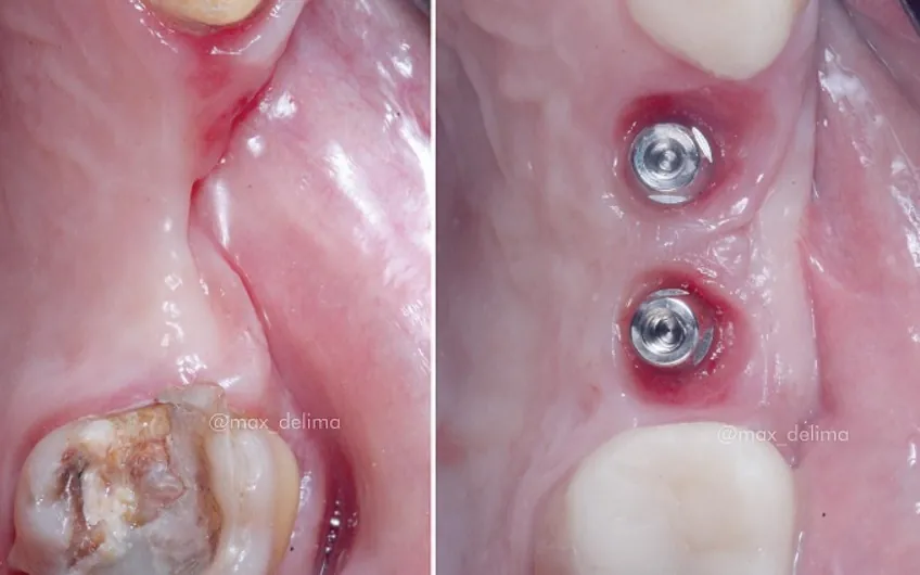 Antes e depois de implantes feitos no Instituto: à esquerda, a raiz de um dente destruído; à direita, dois implantes já instalados na gengiva cicatrizada.